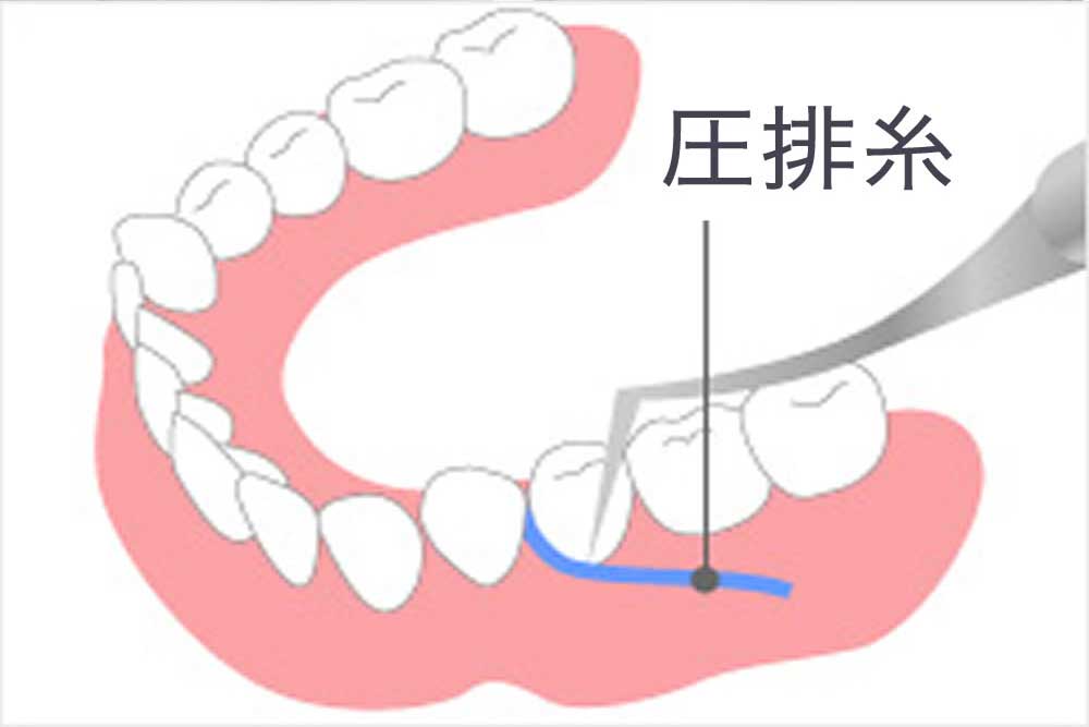 歯肉圧排(しにくあっぱい)