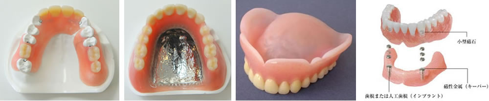 豊富な入れ歯素材
