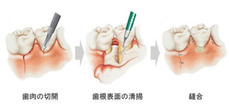 歯周外科