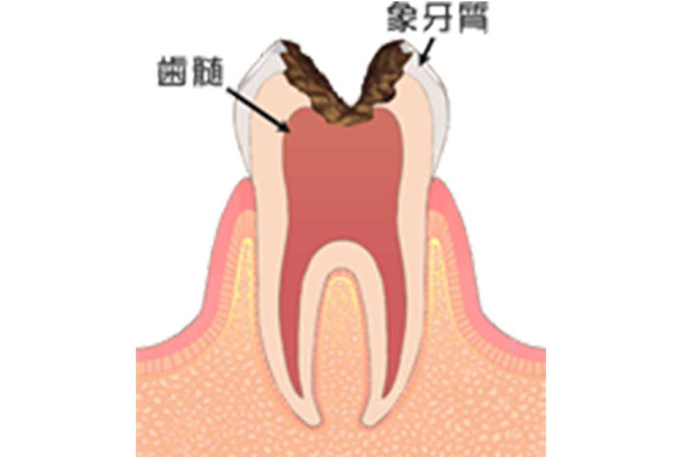 むし歯の治療