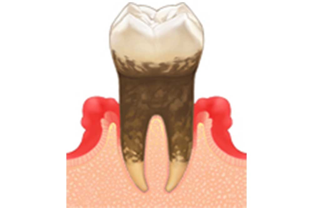 歯周病の治療